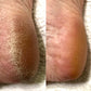 LOVASKIN INSTANT FOOT PEELING Kit Essentiel  - Valeur sûre, 25 soins dans une bouteille