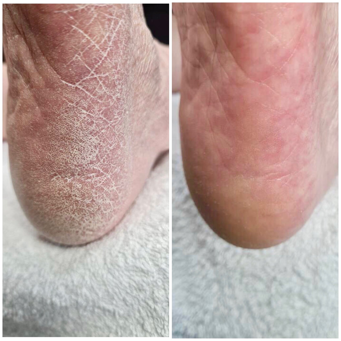 LOVASKIN PEELING INSTANTANÉ POUR LES PIEDS Flacon de Voyage - Plus de 10 soins de beauté pédicure